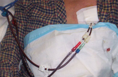 A close up of the port in Jean Del Muto's chest that was used for dialysis. She needed regular dialysis treatment while waiting for the kidney transplant.
(Bradd Del Muto)